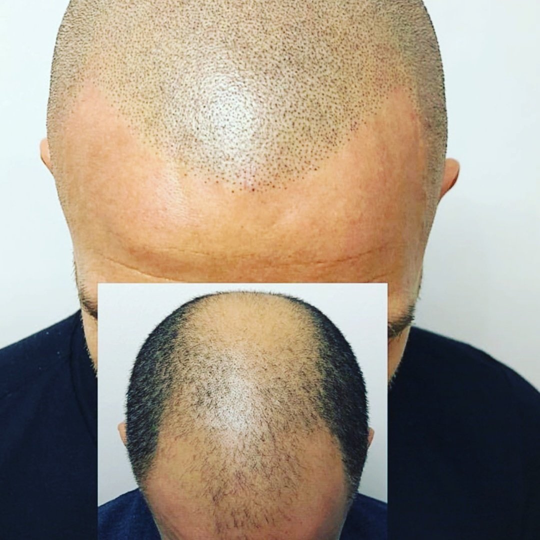 micropigmentation