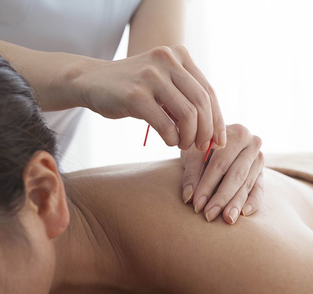 back acupuncture